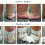 Orthotic success stories: Four cases in a series