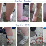Orthotic success stories: Four cases in a series