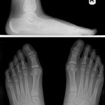 Flatfoot questions: Risk factors and assessment